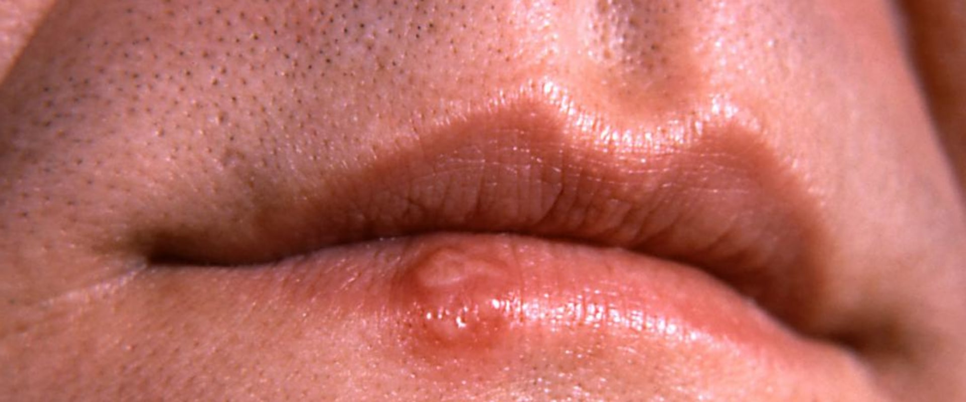 The Surprising STD That Causes Flu-Like Symptoms