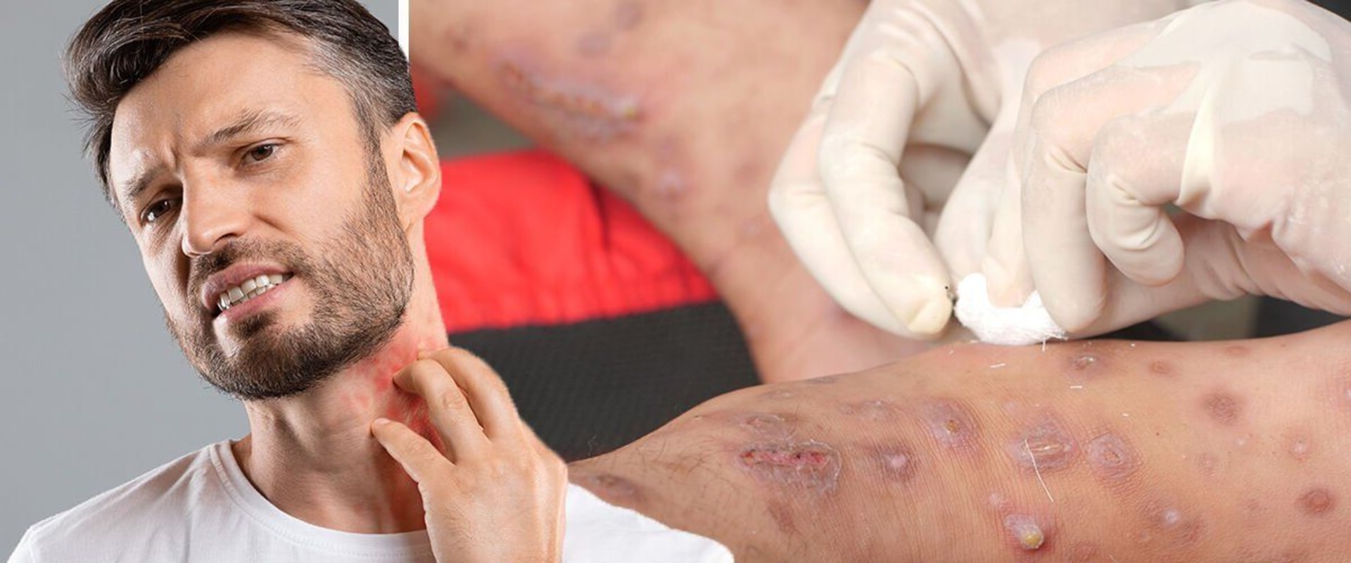 Can You Get STDs Through Skin Contact?