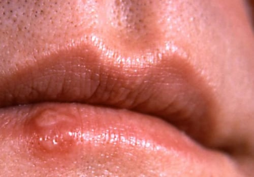 The Surprising STD That Causes Flu-Like Symptoms