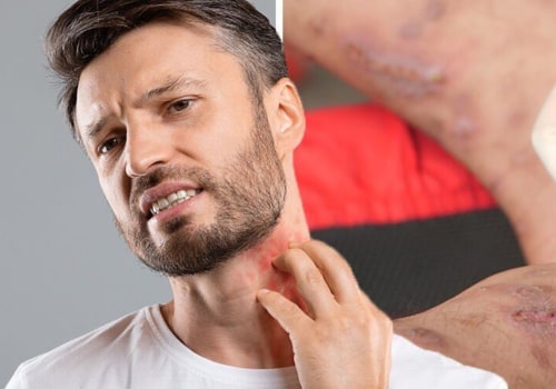 Can You Get STDs Through Skin Contact?
