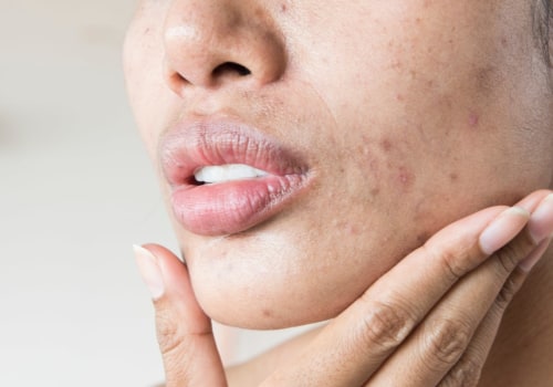 The Surprising Connection Between STDs and Cold-Like Symptoms